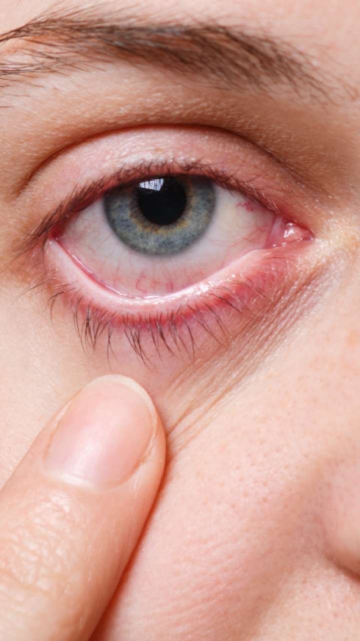 Can eye flu also be caused by looking at the eyes? know the facts